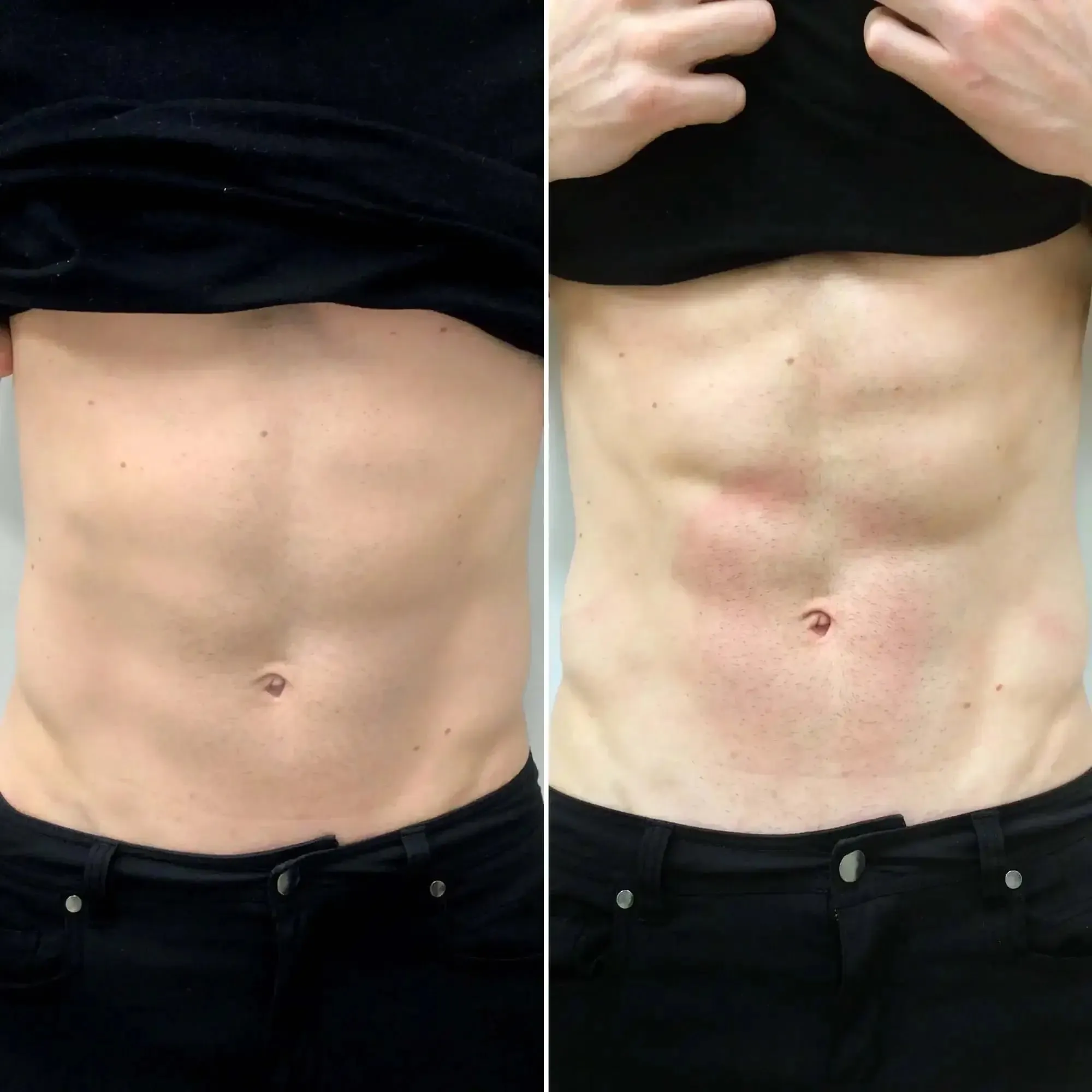 AbFix: EmSculpt Neo