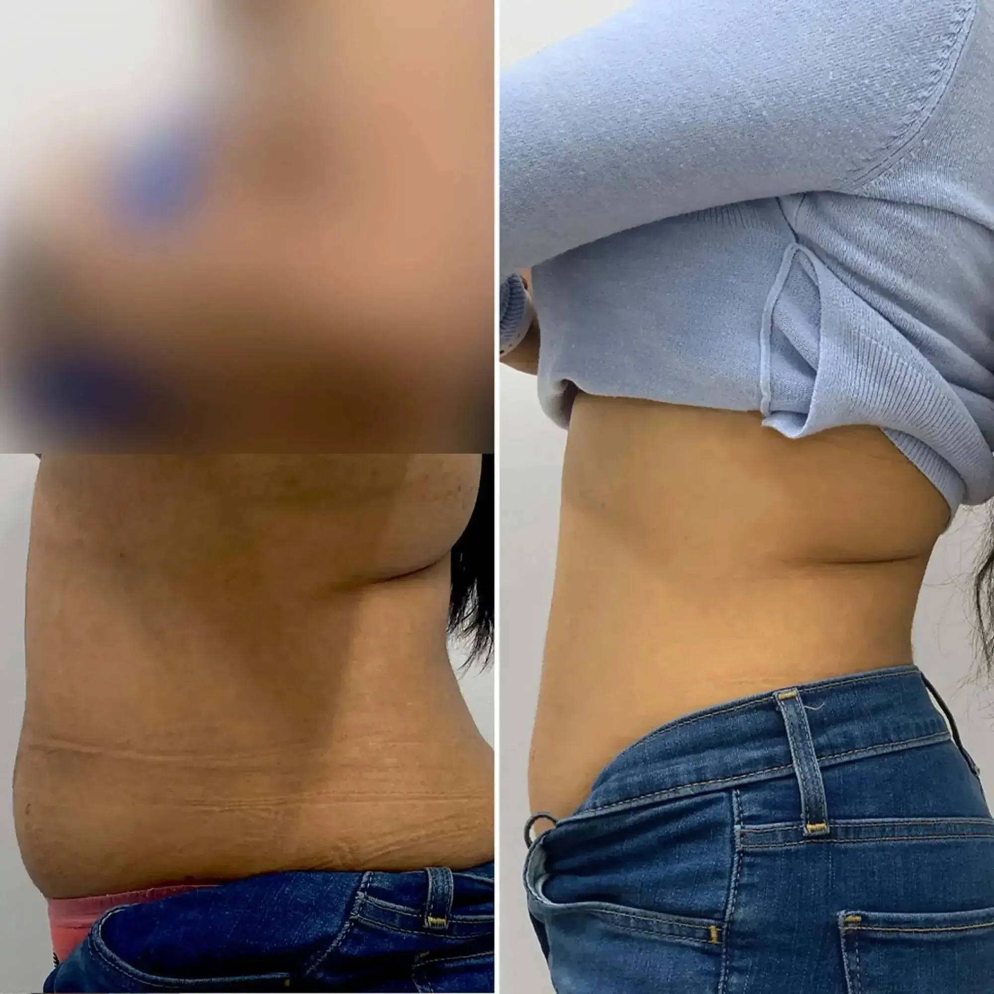 AbFix: EmSculpt Neo